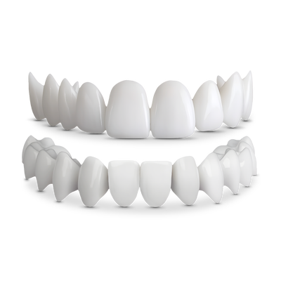 Shiny Smile Veneers